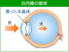 白内障の眼球